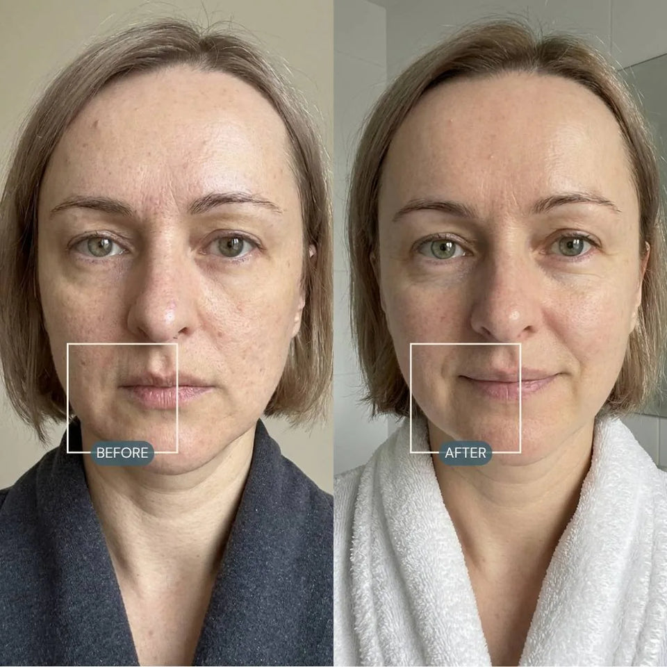 Before and after photos showing firmer-looking skin after 12 weeks