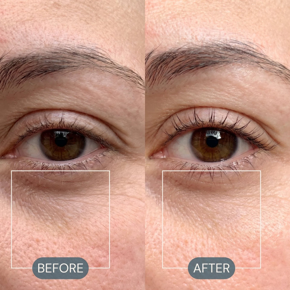 Before and after under-eye photos showing softer-looking lines