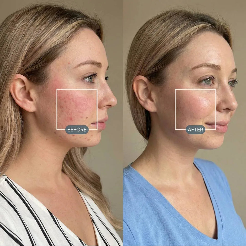 Before and after photos showing clearer and smoother-looking skin