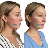 DualLight® Laser + LED Light Therapy Face Mask view 12